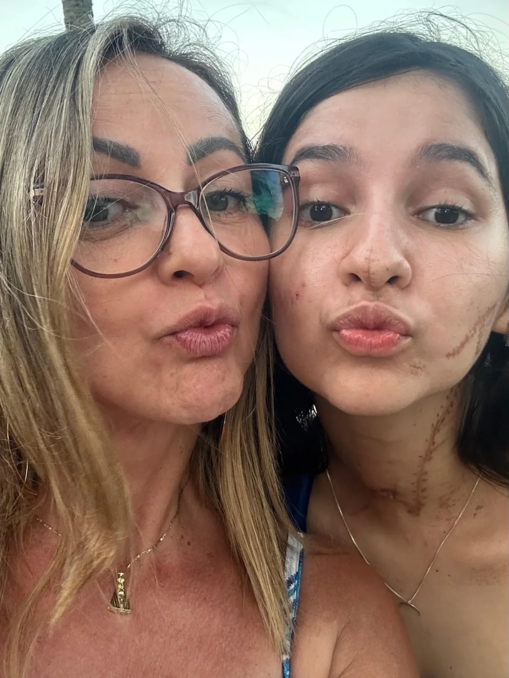 Ufa! Após levar 30 facadas por negar namoro, Alana celebra 1º passeio pós-alta