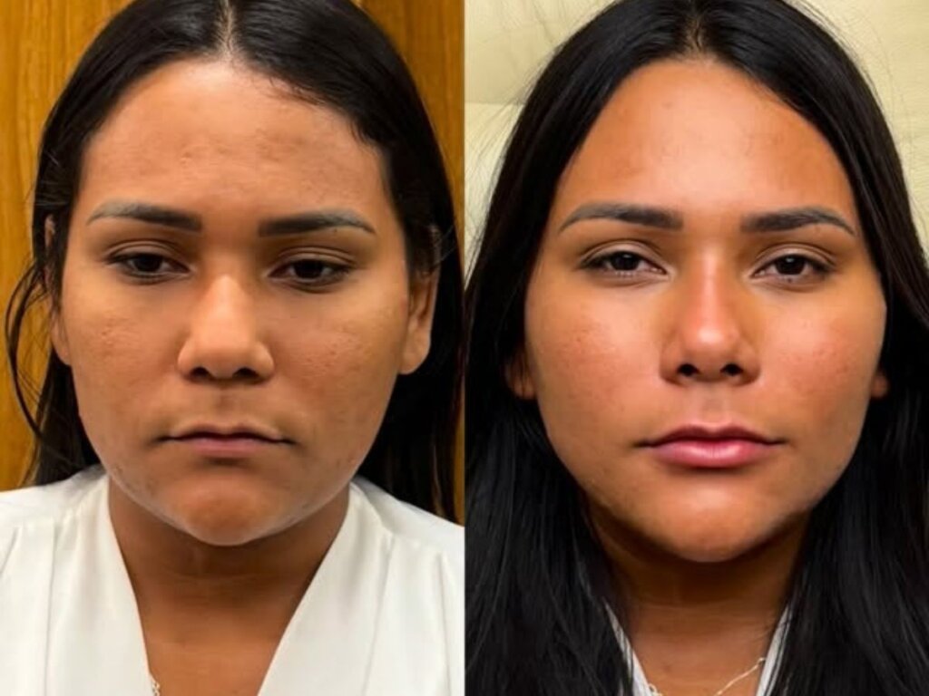 Ex-BBB Chaiany Andrade choca com harmonização facial, mas profissional garante: ‘Sem exageros!’