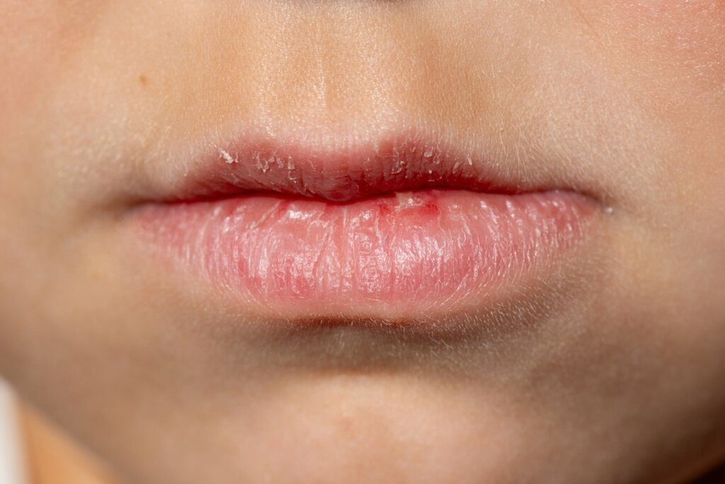 Alô, Lábios Ressecados! Dermato explica: Manteiga de Cacau ou Hidratante, qual é o MELHOR para o frio?