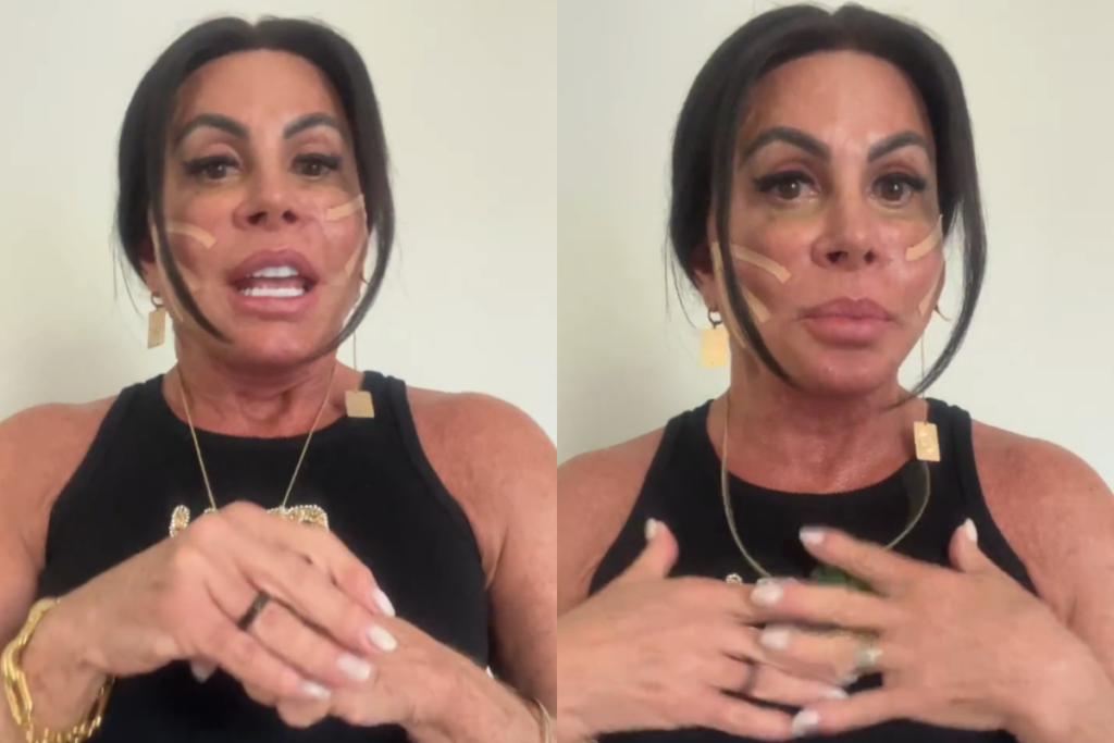 Gretchen Aposta em Fios de Sustentação, Mas Médica Alerta: Efeito é Sutil e Passageiro!