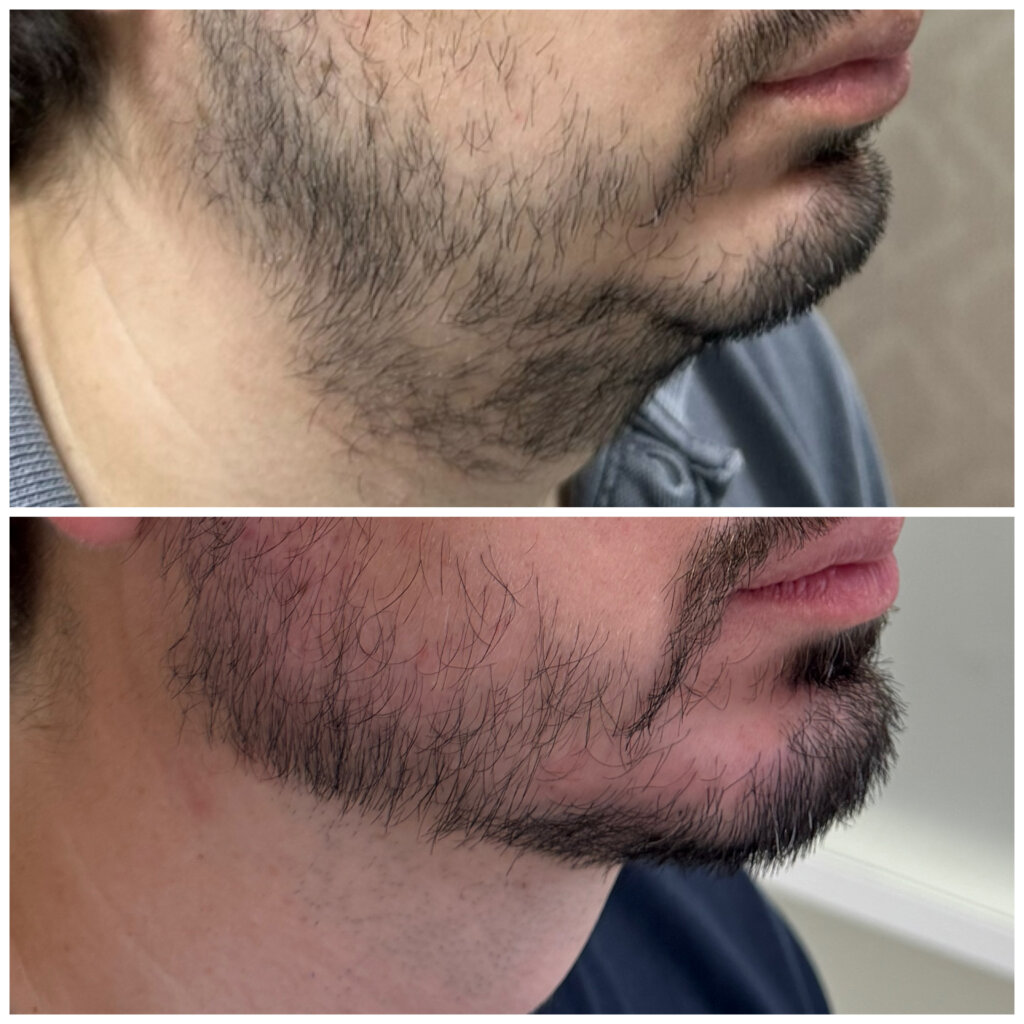Famosos Dão “Game Over” aos Preenchedores: Dr. Guidi Revela O Segredo da Nova Beleza Natural!