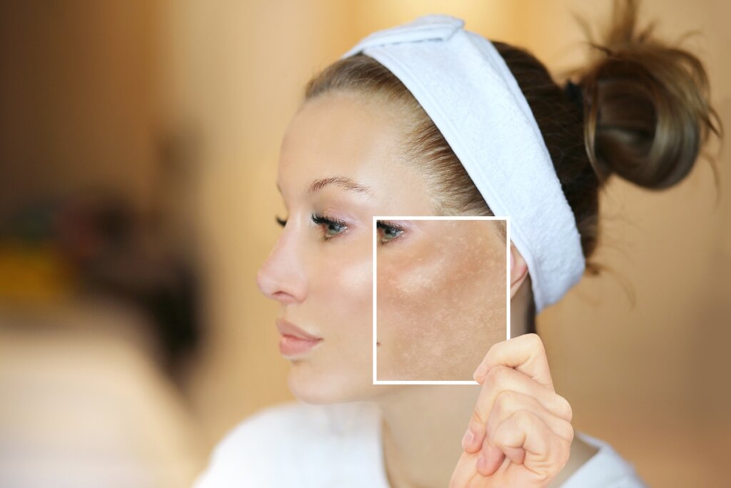 Melasma: Sua Pele Não Esquece! Entenda Por Que Ele Volta