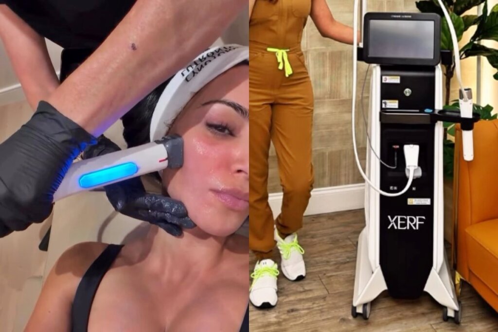 XERF: O Tratamento Que Promete Rejuvenescer a Pele Divide Opiniões!