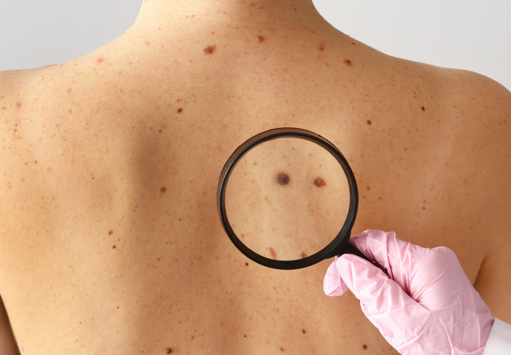Melanoma: Vacina Personalizada Chega Pra Revolucionar a Luta Contra o Câncer de Pele!