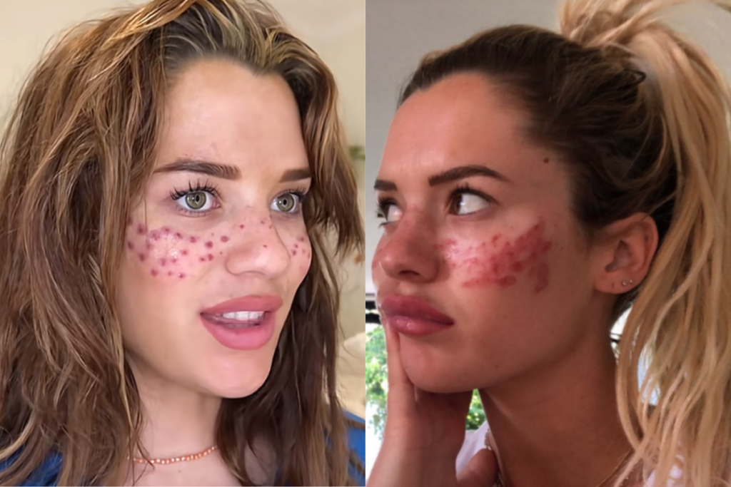 Alerta Farofa! Influenciadora Tilly Whitfeld vai parar no hospital após desastre com tatuagem de sardas caseira