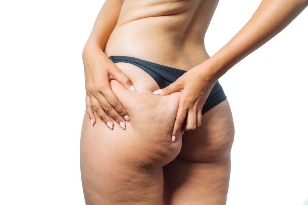 Celulite na Corrida: Não é Miragem, é Super Normal e Tem Explicação!